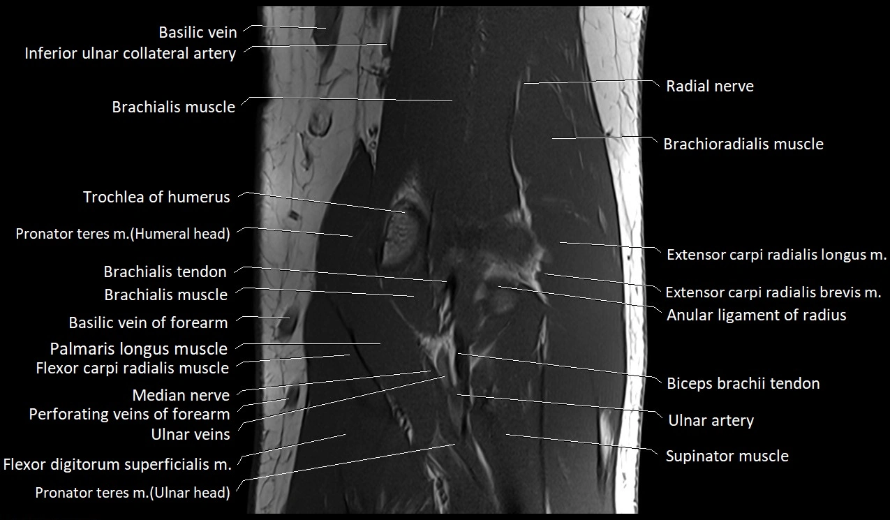 Elbow coronal anatomy image  cross sectional 3T MRI image 15.webp